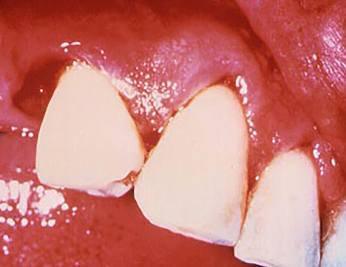 Fluido Gingival Crevicular